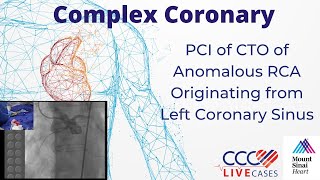 PCI of CTO of Anomalous RCA Originating from Left Coronary Sinus  March 18 2014 Webcast Video [upl. by Adnuhser]