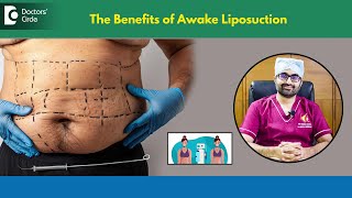 Is quotAWAKE LIPOSUCTIONquot safeKnow how Awake Liposuction works DrAniketh VenkataramDoctors Circle [upl. by Germaine932]