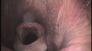 Dynamic endoscopy  epiglottic entrapment [upl. by Nayb]