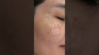 Say goodbye to melasma in just 3 sessions  incredible results at our clinic [upl. by Rich]