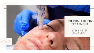 Microneedling I Facial Rejuvenation I StepByStep [upl. by Llenrap]