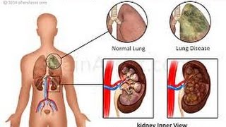 Goodpasture Syndrome [upl. by Namrehs]