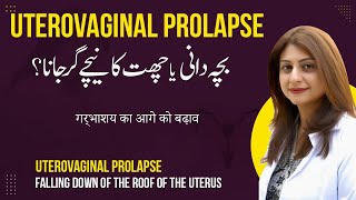 Bacha Dani Ya Chatt Ka Niche Gir Jana  Uterovaginal Prolapse in UrduHindi [upl. by Bowler92]