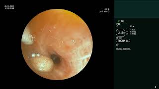 Endobronchial Carcinoid  Bronchoscopic retrieval [upl. by Fawcette748]