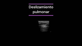 Punto pulmonar [upl. by Bohman]