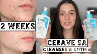 TESTING CERAVE SA CLEANSER amp LOTION ON MY DRY ACNE SKIN FOR 2 WEEKS [upl. by Waldemar805]