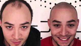 Scalp Micropigmentation Before and Afters [upl. by Gavini]