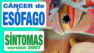 Cáncer de Esófago  Síntomas [upl. by Seyler244]