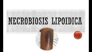 Necrobiosis Lipoidica [upl. by Sadnac625]