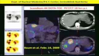 Neuroendocrine Tumors Diagnosis amp Treatment w Peptide Receptor RadiotherapyPRRT Dr Baum 2of2 [upl. by Ellett304]