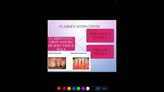 PERIODONTAL POCKET [upl. by Nahraf555]