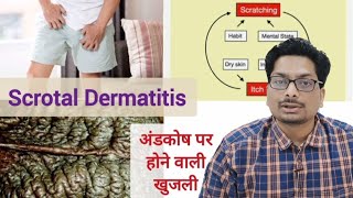 अंडकोष पर होने वाली खुजली का कारण  Part 1 Scrotal Dermatitis  Scrotal Eczema scrotaldermatitis [upl. by Ilrebmik]