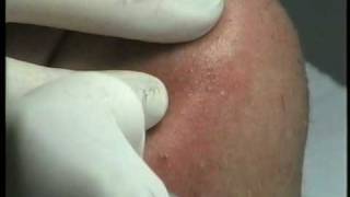 Electrolysis treatment of chin hairs [upl. by Hoang]