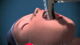 Endotracheal Intubation Animated [upl. by Lolande]