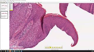 Clear cell acanthoma [upl. by Ahsinot]