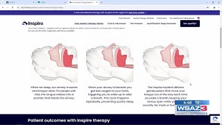 Inspire sleep apnea treatment [upl. by Ahsitauq]