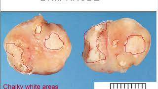 Chronic Lymphadenitis gross and microscopic features for medical students [upl. by Aniala]