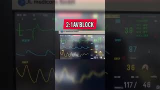 Second degree AV block ecg cardiology heart heartphysiology [upl. by Aicnelav]