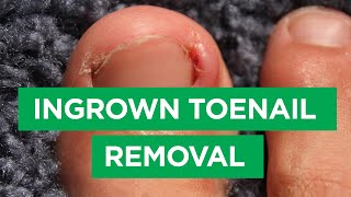 HOW TO TREAT YOUR BIG THICK RAMS HORN TOENAIL  FOOT HEALTH MONTH 2018 14 [upl. by Acinnad659]