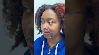 Keloid Removal For Acid Attack Survivor plasticsurgery [upl. by Atteuqahc852]