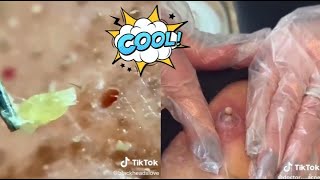 Ultimate Satisfying Acne Removal Compilation Best Pimple Pops Blackheads and Cysts [upl. by Jehovah805]