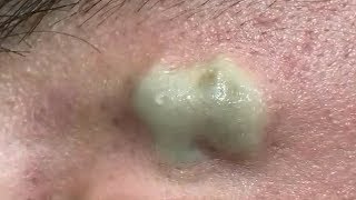 LARGE Blackheads Removal  Satisfying Blackhead 2019 Part 03 [upl. by Wagoner]