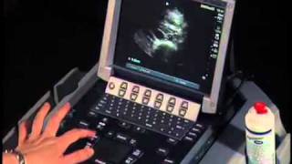 How To Abdominal Ultrasound  Aorta Measurements [upl. by Hescock]