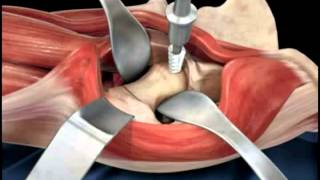 Hip replacement surgery techniques  Dr Scott Devinney [upl. by Ellmyer]