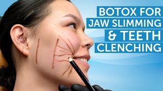 Botox for Jaw Slimming and Teeth Clenching  AAFE [upl. by Elatnahc]