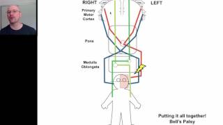 Hemiplegia 4 [upl. by Stokes]