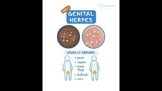 Genital Herpes [upl. by Yenttihw611]