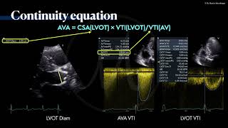 〖Echocardiography〗 The continuity equation in AS  a case example 📖 [upl. by Vivia664]