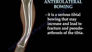 Tibial Bowing  Everything You Need To Know  Dr Nabil Ebraheim [upl. by Schoening]