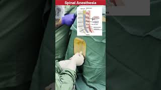 How spinal Anesthesia procedure is performed in Surgery doctor mbbs neet medical anesthesia [upl. by Aneehsyt]