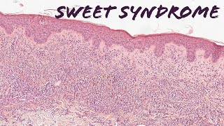 Sweet syndrome explained in 5 minutes pathology histology dermatology dermpath USMLE [upl. by Atenahs340]