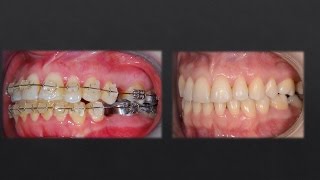 Watch How Orthodontist corrected teeth with Braces [upl. by Chapen802]