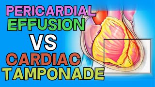 Cardiac Tamponade Pathophysiology Etiology Symptoms Diagnosis and Management Animation [upl. by Marguerita]