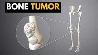 Bone Tumor Causes Signs and Symptoms Diagnosis and Treatment [upl. by Isaacs]