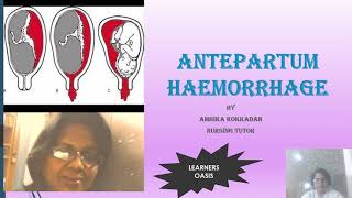 ANTEPARTUM HAEMORRHAGE APH [upl. by Arv]