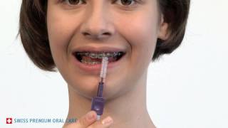 Interdental Brushing with Braces [upl. by Hildie]