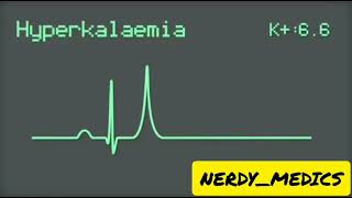 Electrocardiography  ECG changes in HYPERKALEMIA [upl. by Durrace959]