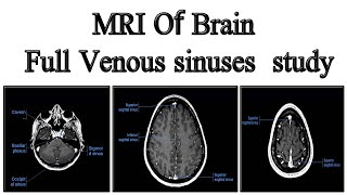 MRI Of Brain Venous sinuses study [upl. by Windzer]