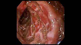 Gastroduodenitis [upl. by O'Dell]