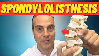 What Is Spondylolisthesis What Is Anterolisthesis Dr Walter Salubro Chiropractor in Vaughan [upl. by Todhunter]