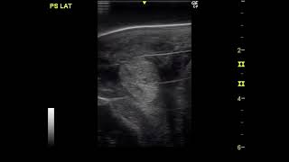 Dr Riccio  Low Frequency Ultrasound Treatment of Suspensory Ligament Branches Desmitis  Video 2 [upl. by Lejeune]