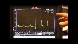 Secondary Ignition Waveforms common faults [upl. by Aikehs]