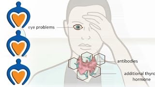 Thyroid problems  most common thyroid problems symptoms and treatment [upl. by Elbring]