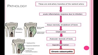 chronic osteomyelitis [upl. by Poock]