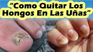 HONGOS EN LAS UÑAS TRATAMIENTO Como Eliminar Los Hongos De Las Uñas Delos Pies o De Las Manos [upl. by Vachel]