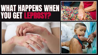 Leprosy Symptoms Types and Whos at Risk Everything You Need to Know [upl. by Maryellen389]